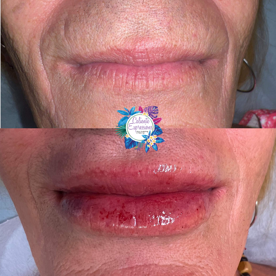 Lip Plumping Treatment