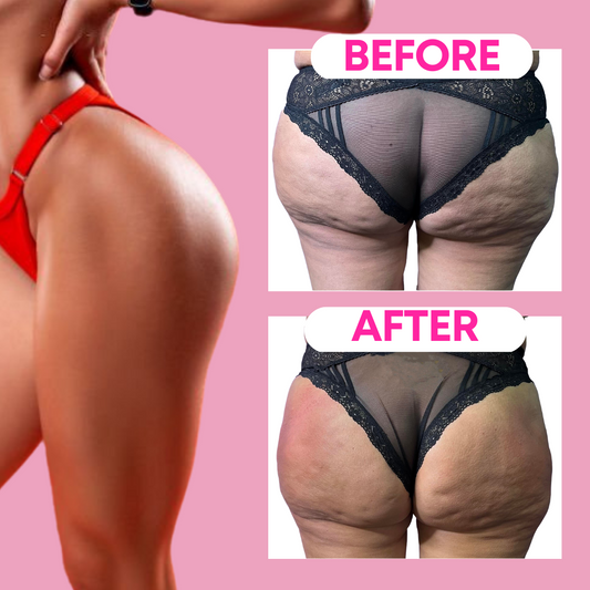 Cellulite Treatment